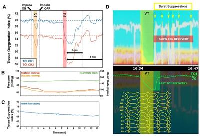 Noninvasive neurological monitoring to enhance pLVAD-assisted ventricular tachycardia ablation – a Mini review